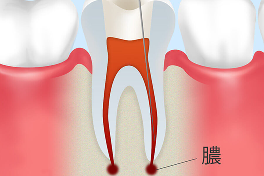重度の虫歯でも歯を残すために～根管治療～