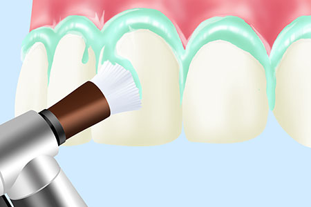 1：歯のクリーニング「PMTC」